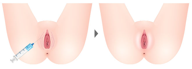 大陰唇縮小形成術 術後約半年再診時