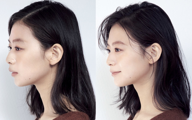 横顔美人の条件は？横顔のセルフケア方法や美容整形の症例を紹介 - WOMクリニック銀座
