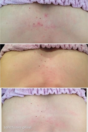 背中・胸のなかなか治らないニキビでお困りの方は福岡早良区の星の原クリニックにどうぞ