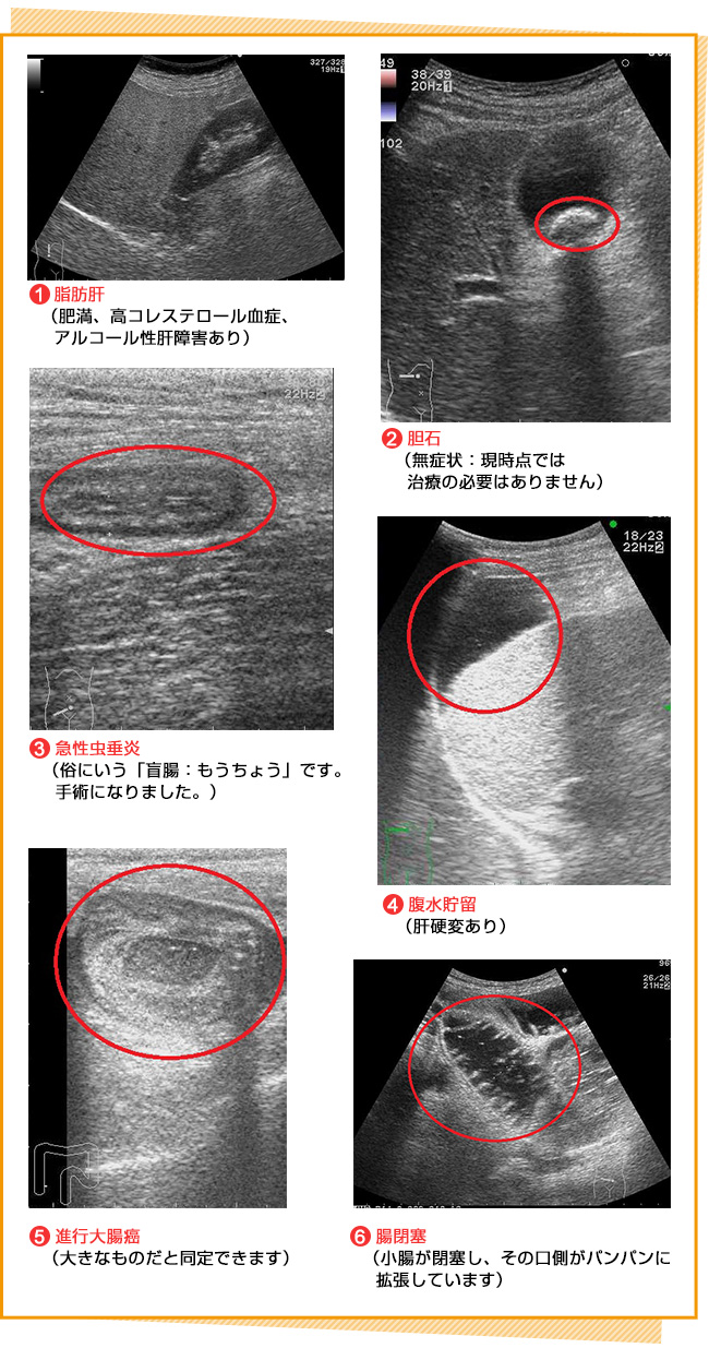 腹部超音波検査阪神西宮駅徒歩30秒の胃カメラ・大腸カメラ ひだ胃腸内視鏡クリニック