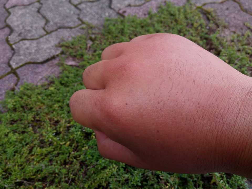 スズメバチ・ハチに刺された体験記４：アシナガバチの巣を探索中に刺される蜂駆除のルイワン