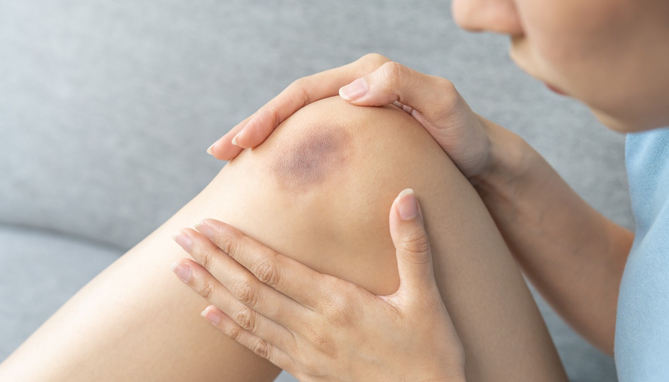 青あざ 異所性蒙古斑・太田母斑 の治療日本医科大学武蔵小杉病院