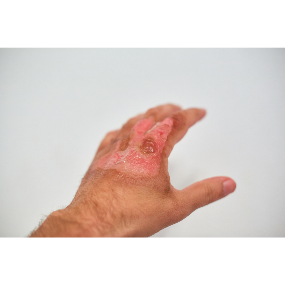 やけどふじた形成外科・皮膚科クリニック長野県松本市イオンモール晴庭3Fあざ・しみ・ほくろレーザー治療・ニキビ・脱毛