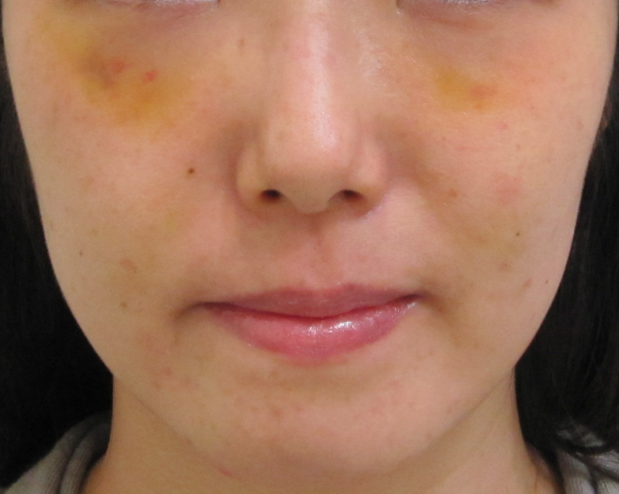 埋没法の内出血はいつまで？早く治す方法や引かない際の対処法も紹介埼玉川口のフェアクリニック