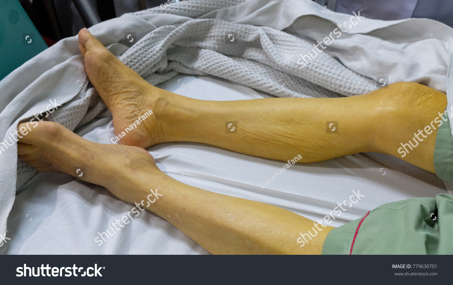 黄疸が出る原因を解説！黄疸と肝臓や胆嚢との関係性は？黄疸の治療法や受診のタイミングをあわせてご紹介 イシャチョク