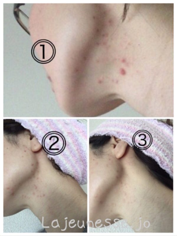 顎下ニキビが繰り返したのは、ストレスで触っていたのだと気付きました和歌山県橋本市エステサロン 微細針美容でニキビケア＆痩身 よもぎ蒸しができるエステサロンシエスタ