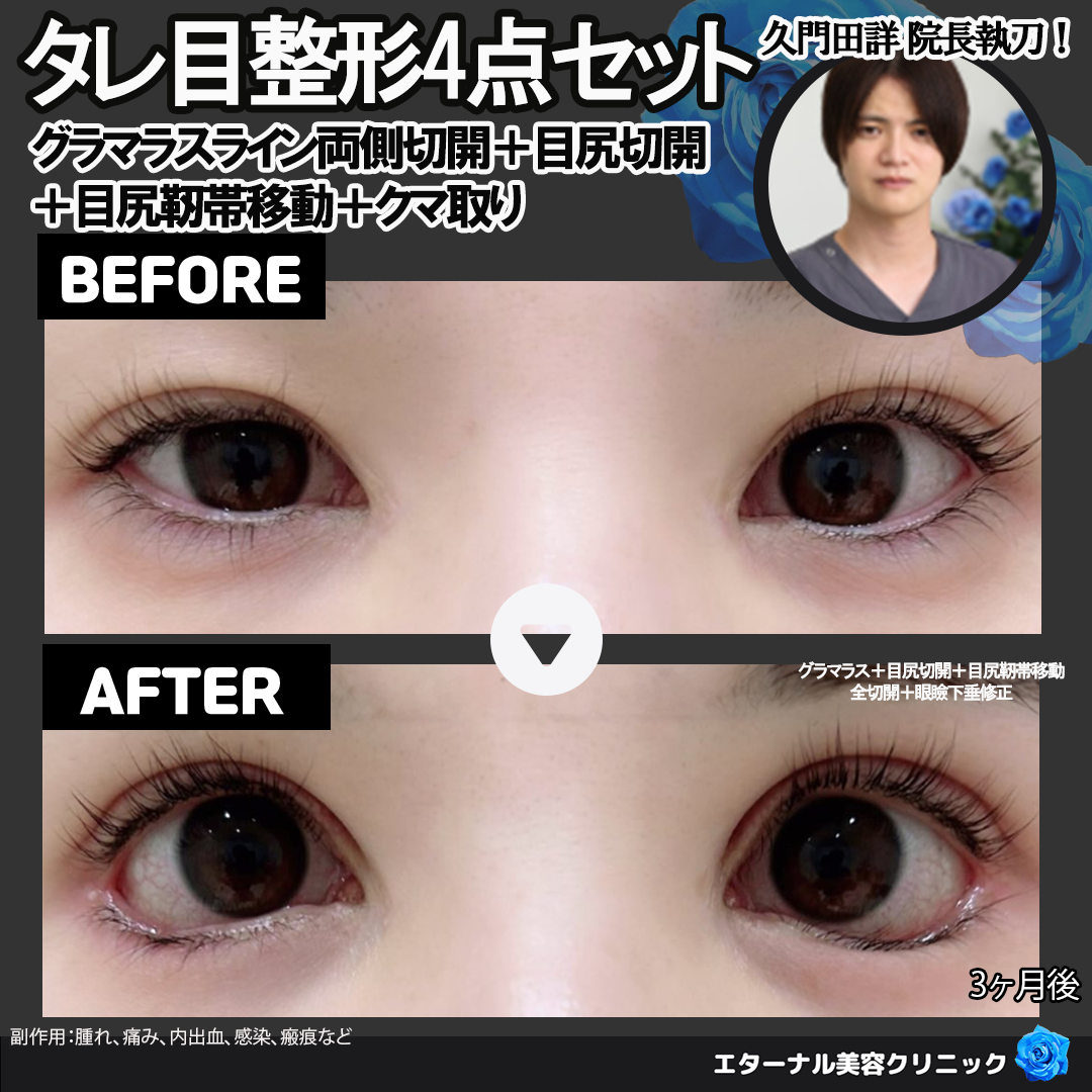 高校生の究極の二重整形‼️二重手術であなたの魅力を最大限に引き出します9beautyclinicりく先生池田陸二重整形二重埋没二重手術末広二重平行二重目頭切開ハム目埋没法アイプチアイプチ卒業アイプチかぶれ銀座美容外科まぶたの脂肪