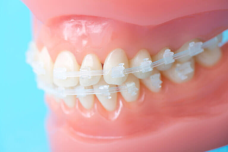 前歯のインプラント治療 交通事故による複数本欠損尼崎市の歯医者なら「みずの歯科・矯正歯科」