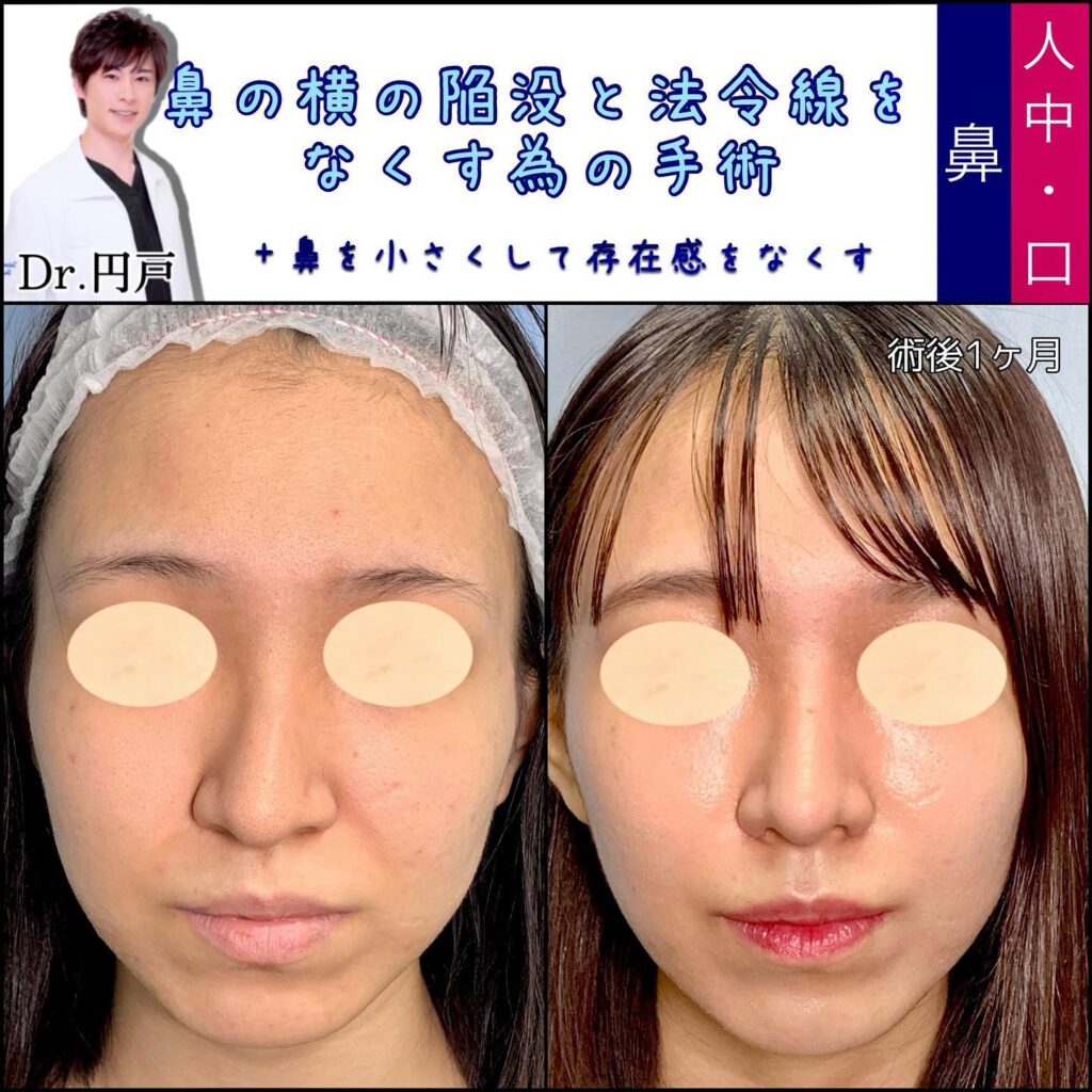 団子鼻洗濯バサミでやってみた結果TikTok