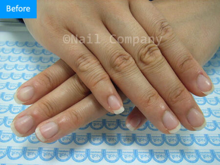 爪の形 を良くしたいのに 親指の爪だけ極端に 爪が短い