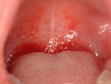 のどの病気 戸塚耳鼻咽喉科クリニック戸塚駅徒歩2分の耳鼻科