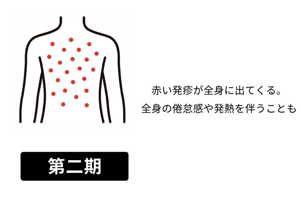 梅毒の症状とは？ 知っておきたい感染経路や検査方法、治療法を徹底解説！sai＋journal サイジャーナル