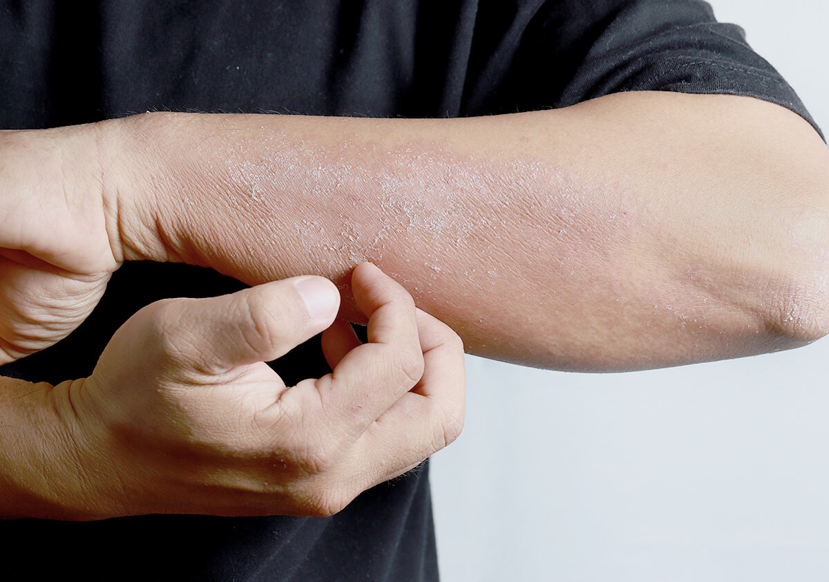 糖尿病に伴った色素性痒疹の1例臨床皮膚科 54巻7号医書.jp