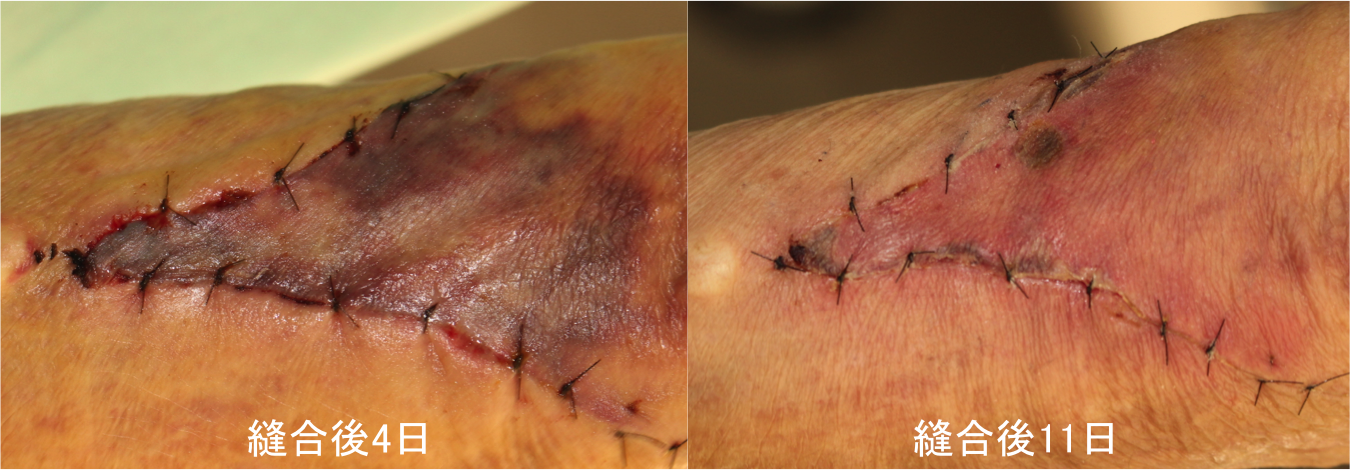 手術 皮膚腫瘍摘出術 の実際の流れ – 医療法人 双英会 YUKI皮フ科形成外科一宮市時之島の皮膚科、形成外科