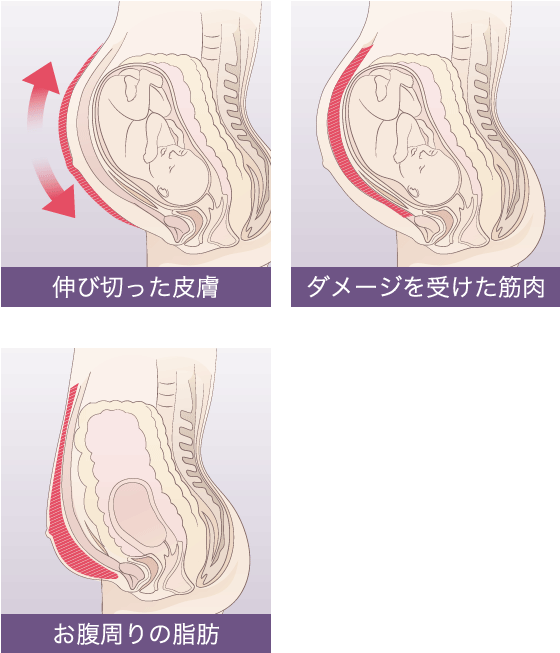 出産後のお腹のたるみを克服してビキニを着こなす秘訣 I リディアンクリニック
