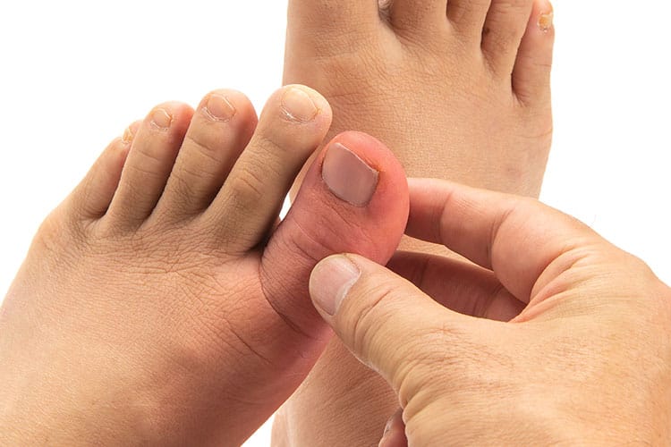 痛風02 - さっぽろ内科・リウマチ膠原病クリニック