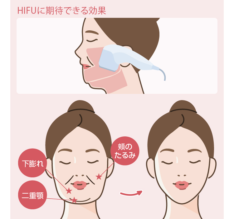 たった1週間で顔痩せ！小顔脂肪吸引の効果と症例写真美容整形クリニックA CLINIC 公式