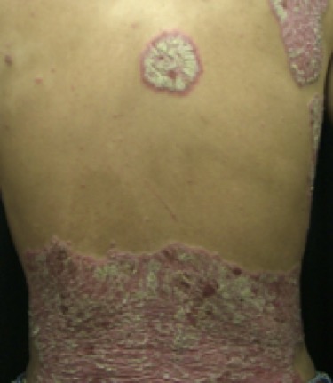 乾癬の種類と症状乾癬ってこんな病気乾癬.comマルホ株式会社