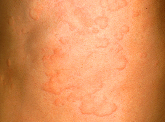 蕁麻疹 じんましん の原因＆対処法薬局・薬店で相談できる皮膚トラブルヒフシルワカル
