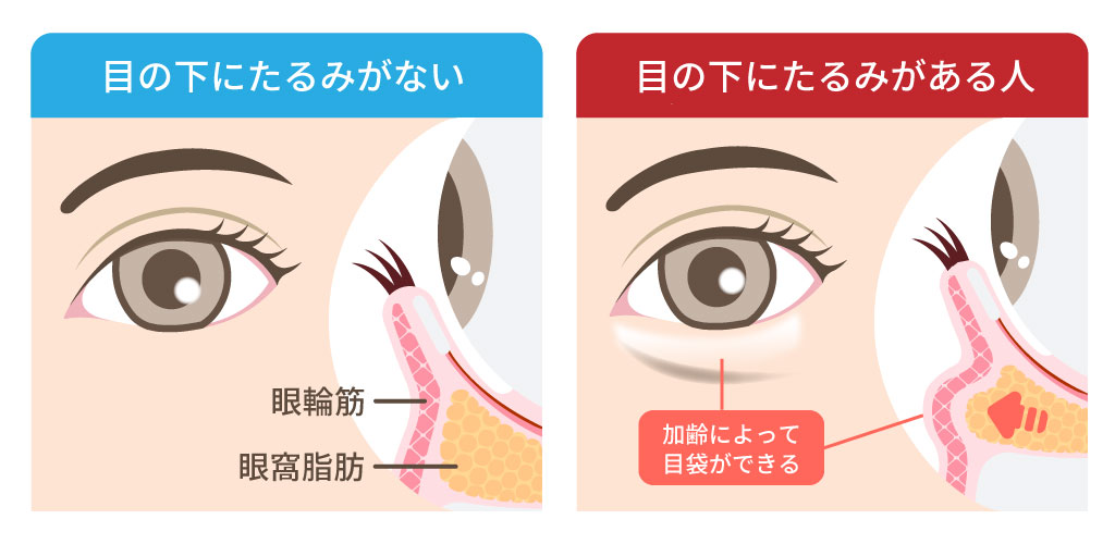 目の下のたるみ、膨らみを改善させるための自宅ケアや治療法について詳しく解説二重まぶた・目の整形なら城本クリニック