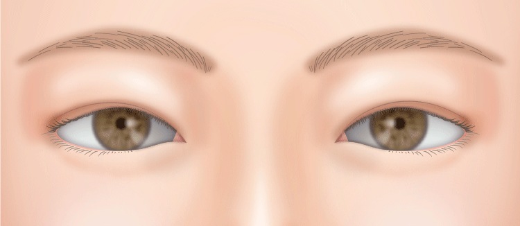 まぶたが腫れ・まぶたが重い あだち眼科