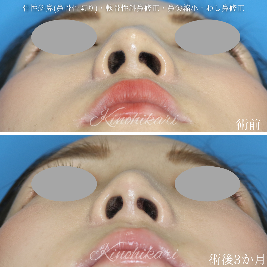 斜鼻・鼻中隔彎曲症 しゃび・びちゅうかくわんきょくしょう 家庭の医学時事メディカル時事通信の医療ニュースサイト