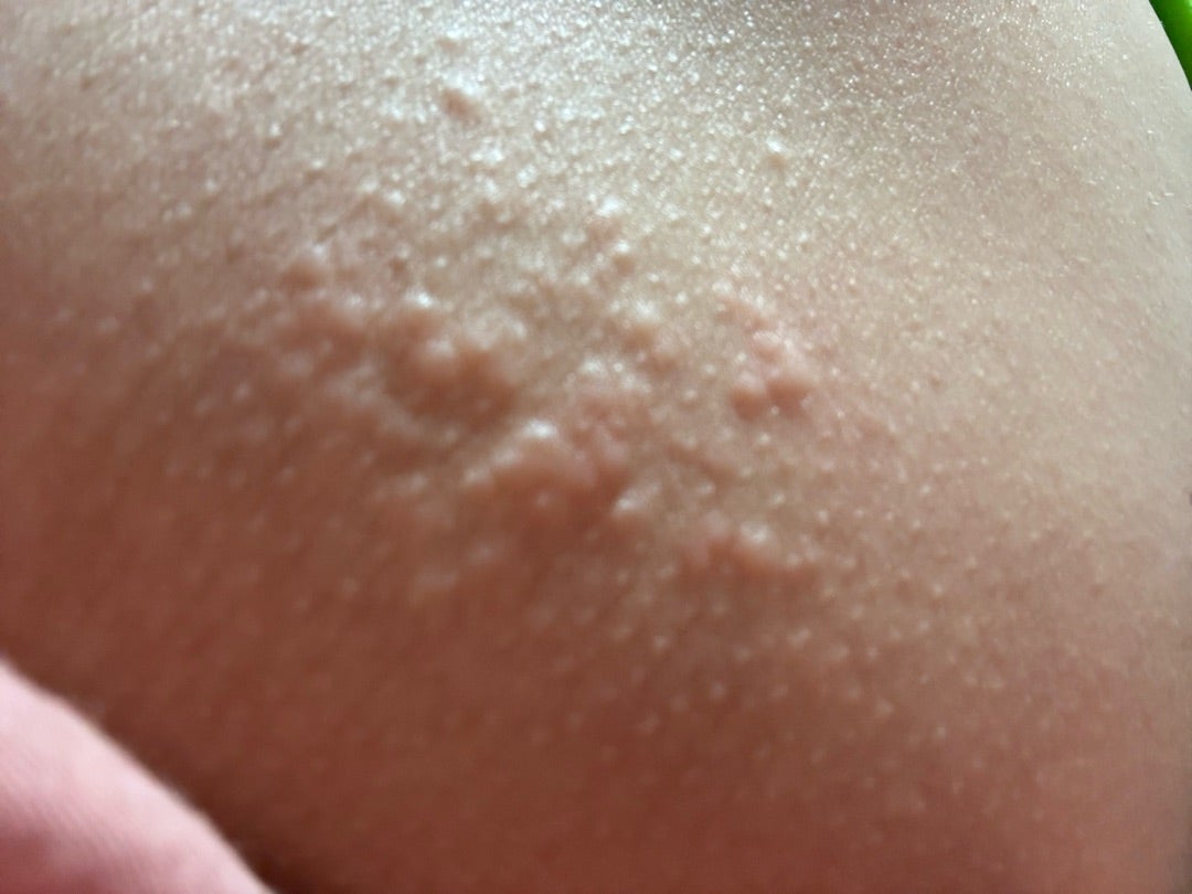 お尻などのブツブツにヒプキュア小林製薬