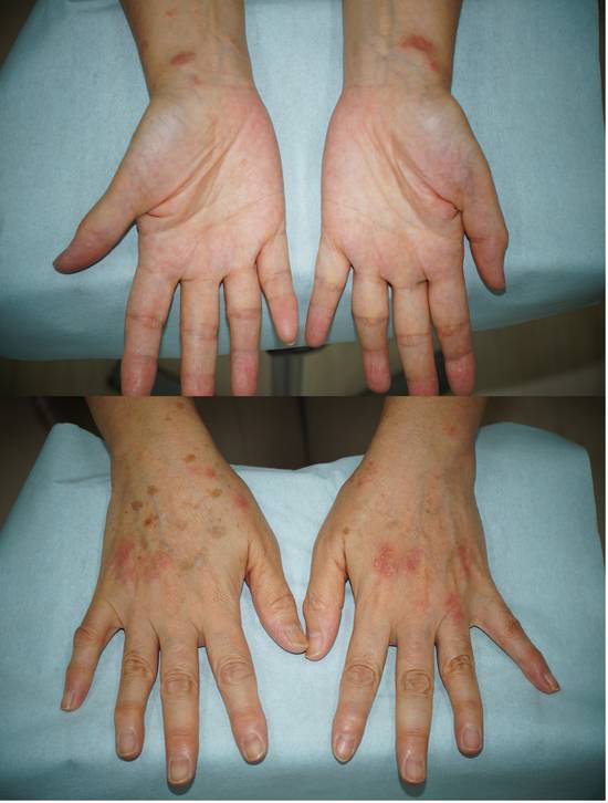 手湿疹 主婦湿疹 湿疹、皮膚炎③看護roo! カンゴルー
