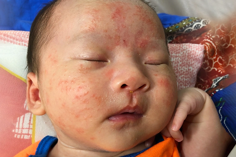 顔が赤い！痒い！ そんな女性の悩みにどう対応？：日経メディカル