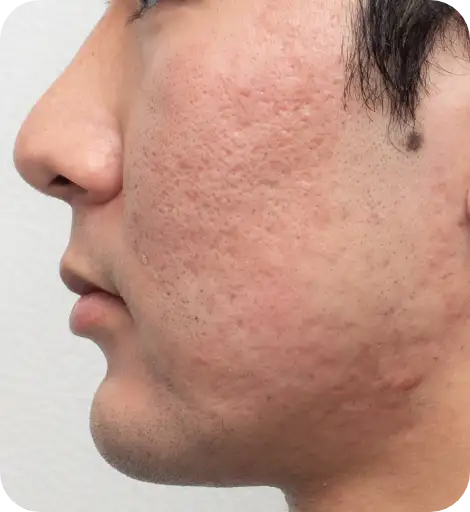 閲覧注意 本当にグロいです。 - 後頭部のニキビ、禿げてる部分が何ヶ所か- Yahoo!知恵袋