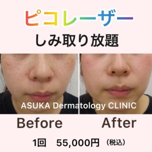 手の甲のシミ取り治療 当院スタッフの治療例Life can be beautiful.みかこクリニック院長 高木美香子のブログ