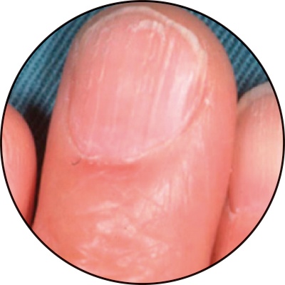 爪の状態でわかる、ご自身の健康状態 その２忍ケ丘の整体を受けるなら「忍ケ丘整骨院・鍼灸院」