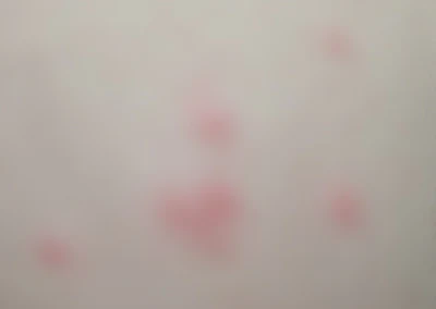 ダニに刺された跡 写真画像あり 症状の特徴や見分け方、跡をきれいに治す方法を紹介