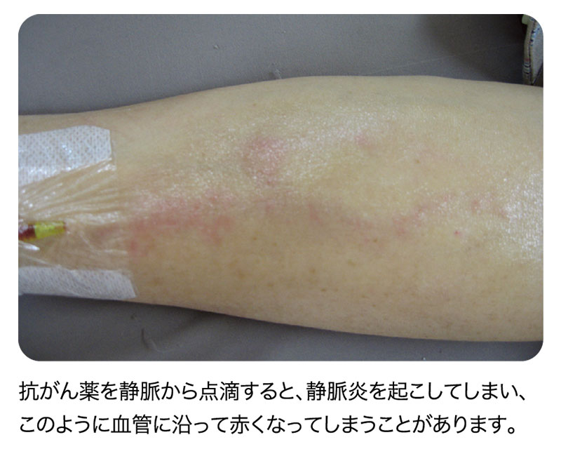 静脈注射 - Wikipedia