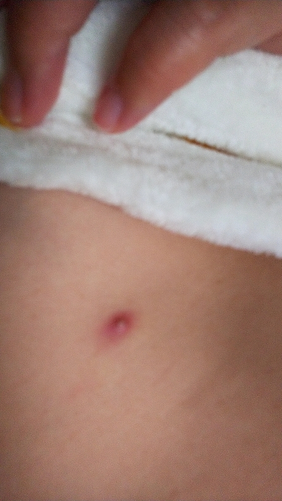 胸に帯状に部分的にみられる湿疹野田市 小児科 千葉県 こどもの花粉症 こどもの漢方 喘息 アトピー性皮膚炎 アレルギー 結節性痒疹たんぽぽこどもクリニック