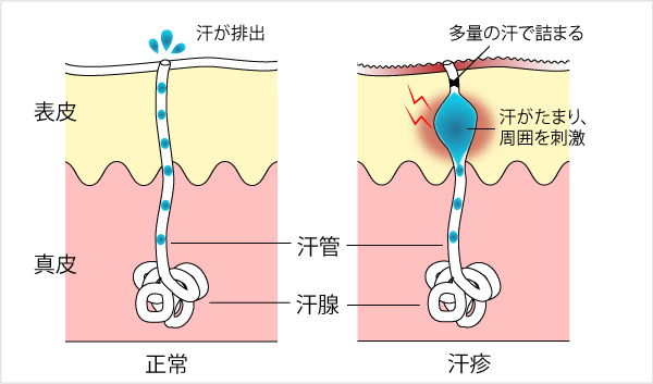 あせも 夏に注意すべき皮膚の病気②あせも 汗疹