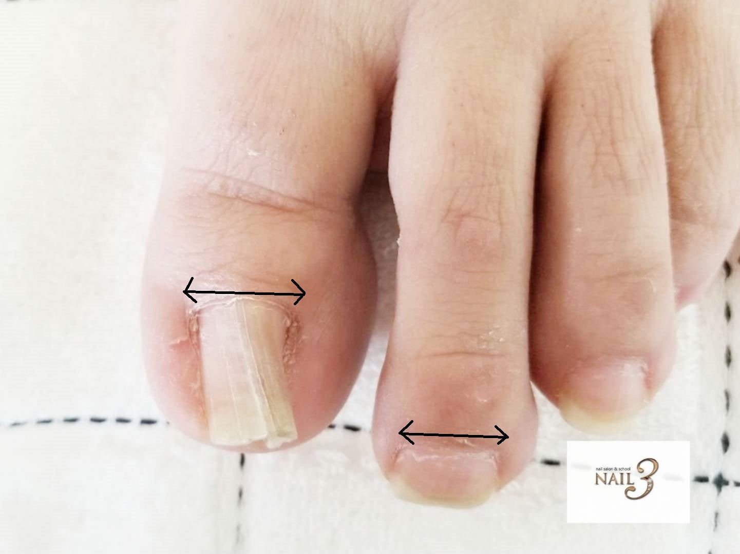 巻き爪・陥入爪の治療交野市・星田駅・枚方市のリア形成外科美容クリニック