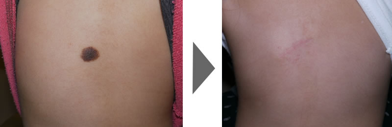 肌に黒いあざのクローズ アップの写真素材・画像素材 Image 34103664