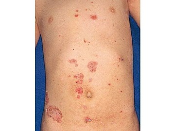 えぬくりブログ: 小児のイボ治療 水いぼ編