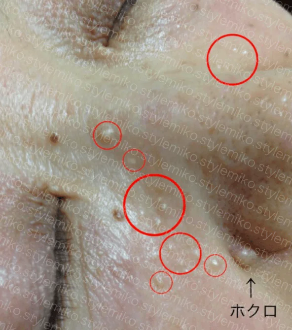 医師監修 子どもの肌のブツブツができた！これは湿疹？それとも病気？コラム 海外オンライン医療相談ヨクミル