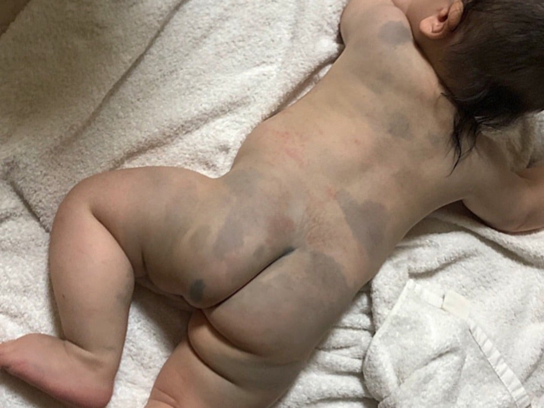 異所性蒙古斑あざ治療の専門クリニック西堀形成外科