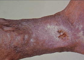 33.diabetic skin ulcer