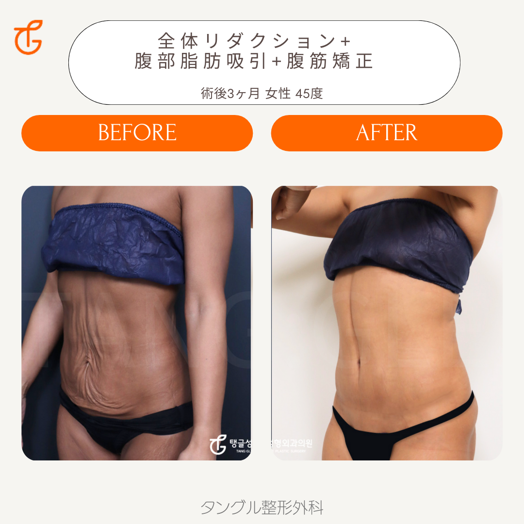 お腹のたるみ タルミ ・妊娠線を消す腹リダクション：美容外科 高須クリニック