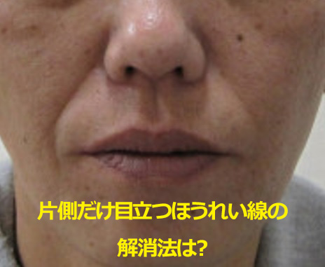 肌の悩み顔の片側は綺麗なのに、もう片側はニキビがひどいんです。何かアドバイスありますか？ : r SkincareAddiction