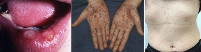 梅毒患者が急増中です！鳥取市