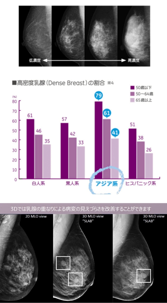 乳房X線検査マンモグラフィ国立がん研究センター 中央病院