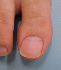 足の親指が爪が黒くなりがちバドミントン、どうすれば良い？本当の理由を教えます。テニスショップ通販店長のブログ＠テニスショップLAFINO 西山克久