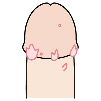 陰部のイボ・ブツブツMENS FAIR ネオ形成のフェアクリニック