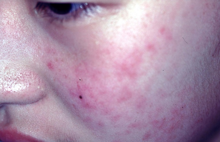 症例紹介 4年間治らなかった顔のかぶれが12日で完治なつい式湿潤療法の効果