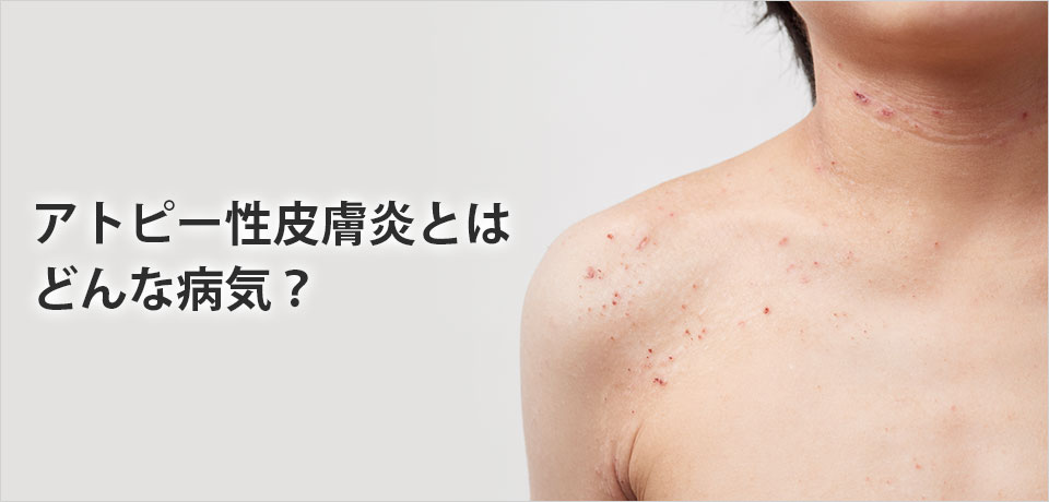 湿疹とは？原因と種類、ストレスからくる皮膚炎を画像で解説 - ヨクミテ医師監修の医療メディア